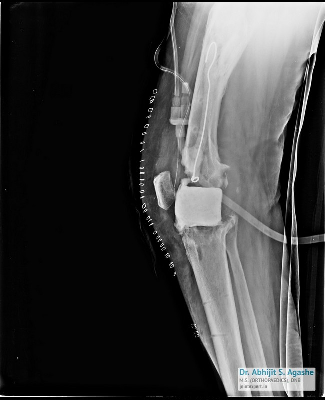 img1revision-knee