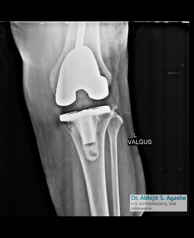 img2revision-knee