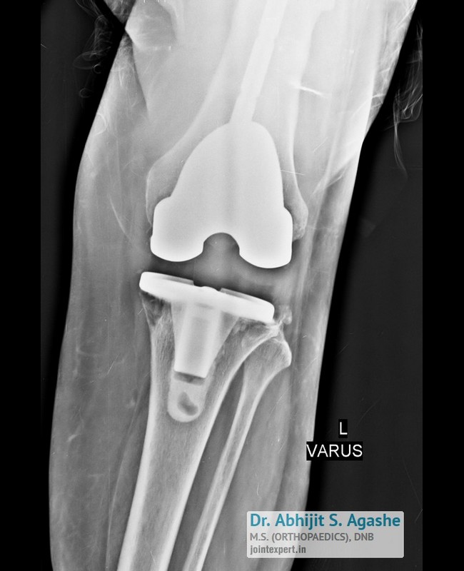 img5revision-knee